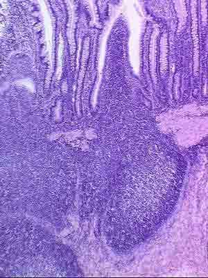 Лимфатические узелки в слизистой оболочке тонкой кишки